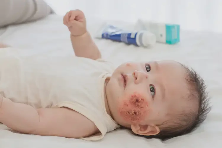 婴幼儿脖子上经常起湿疹能治好吗(图4)