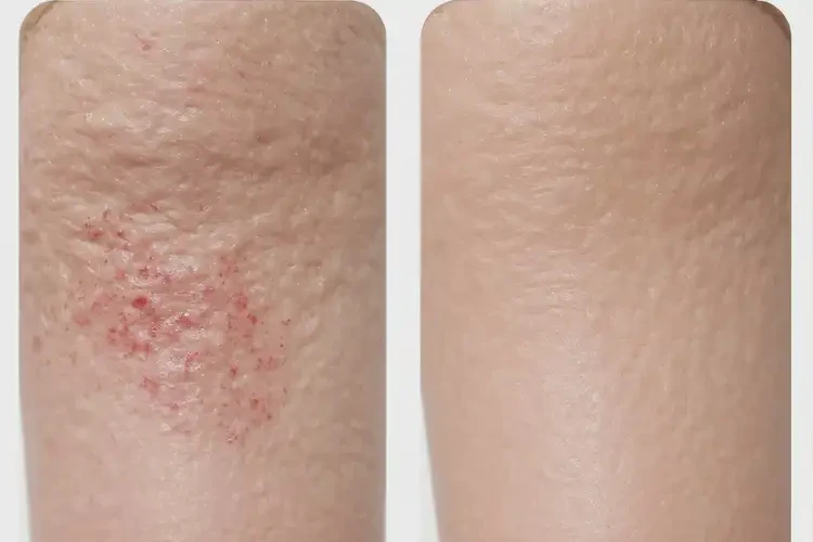 小孩肛周容易长湿疹不管它会自己好吗(图1)