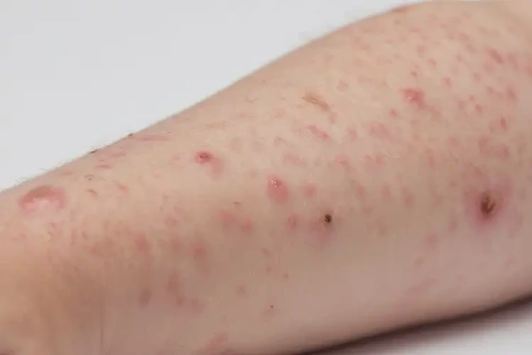 小学生手上长湿疹可以治好吗(图4)