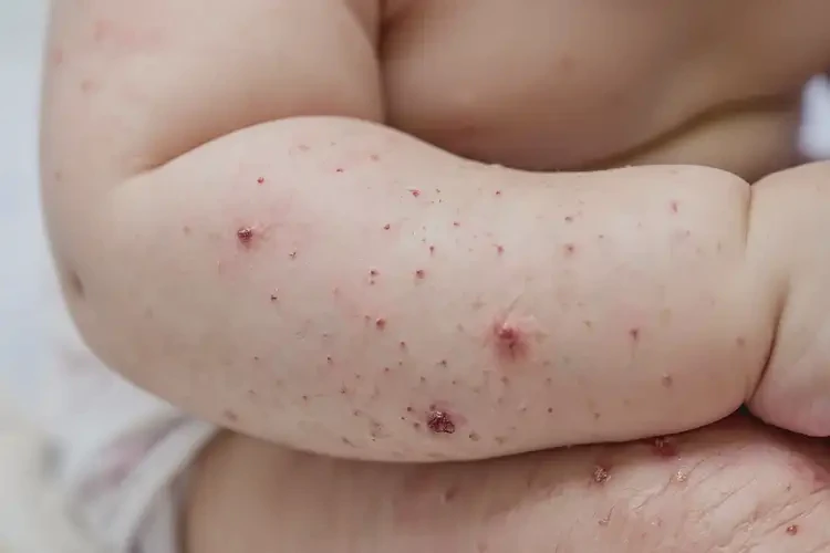 幼儿全身经常起湿疹可以彻底自愈吗(图4)