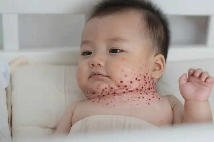 婴儿脖子上出湿疹能治好吗(图4)