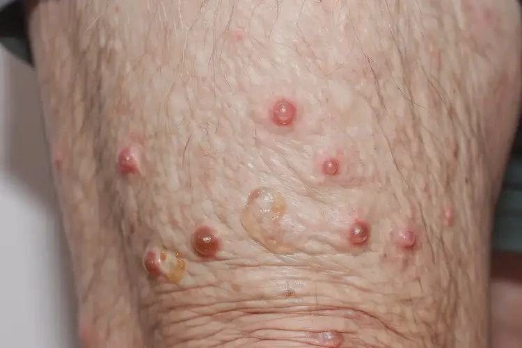 高龄老人大腿偶尔起湿疹可以治好吗(图4)