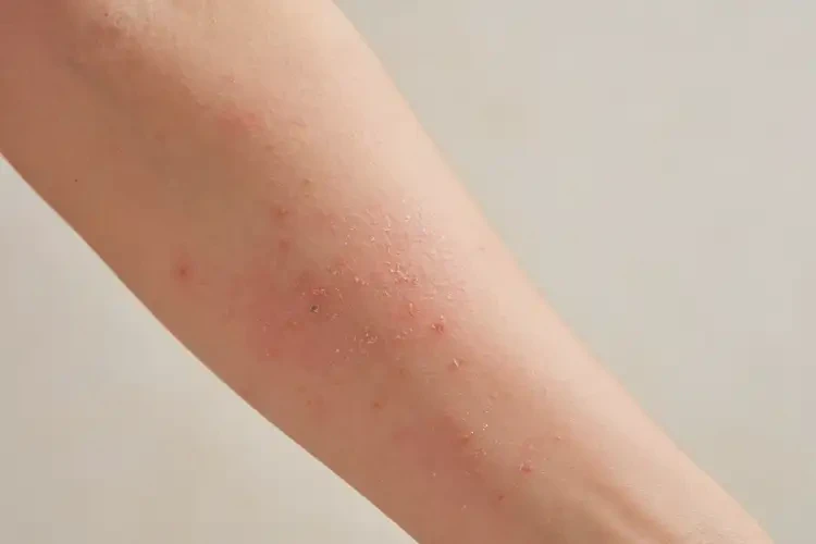 女人手臂偶尔长湿疹可以治好吗(图2)