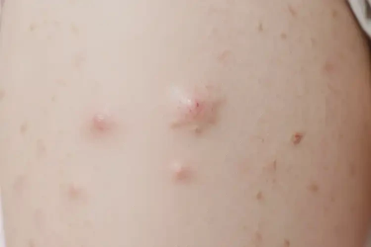 少儿大腿上有湿疹不管它会自己好吗(图4)