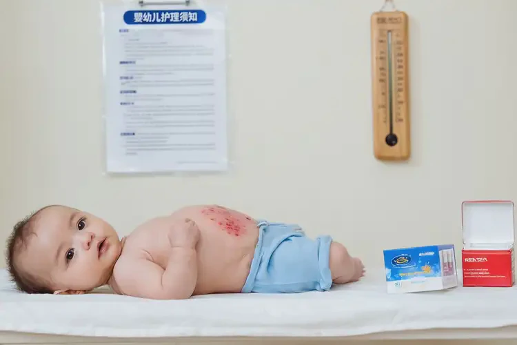 宝宝肚子上起湿疹能治好吗(图4)