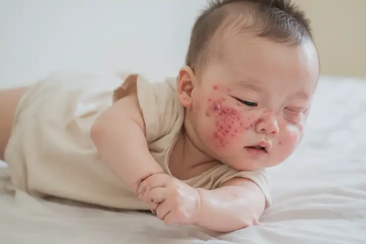 宝宝脸上偶尔起湿疹不管它会自己自愈吗(图3)