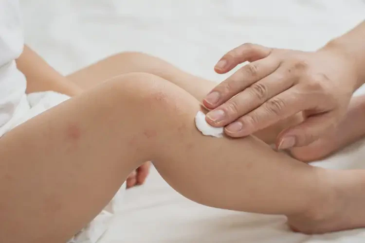 幼儿小腿上经常起湿疹能不能彻底自愈(图1)