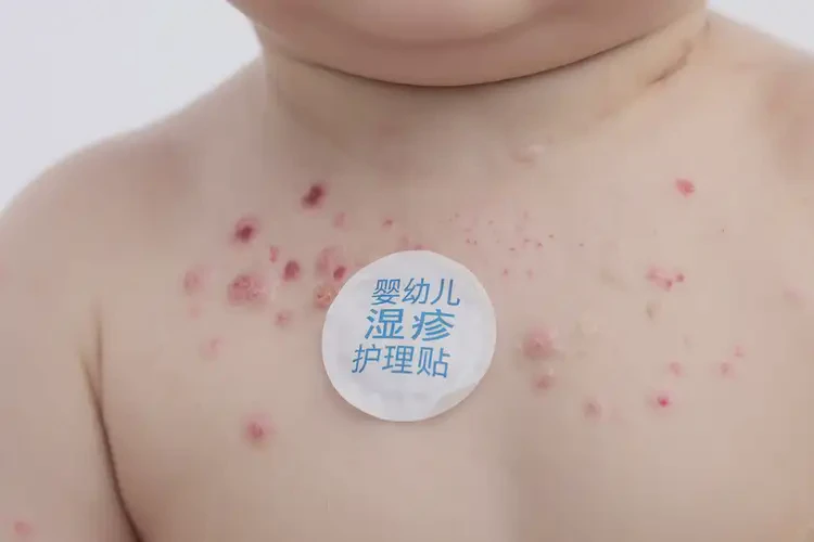 婴幼儿脖子出现湿疹能治好吗(图4)