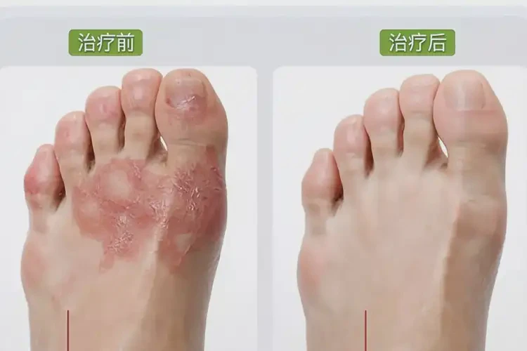 青少年脚上容易起湿疹可以治好吗(图4)