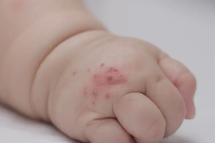 宝宝手上出湿疹能治好吗(图4)