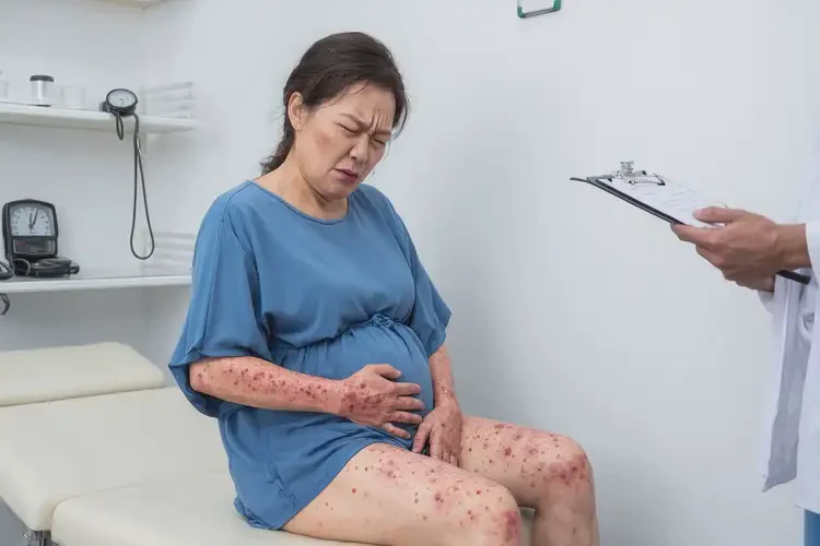 孕妇全身容易起湿疹能靠自己自愈吗(图4)