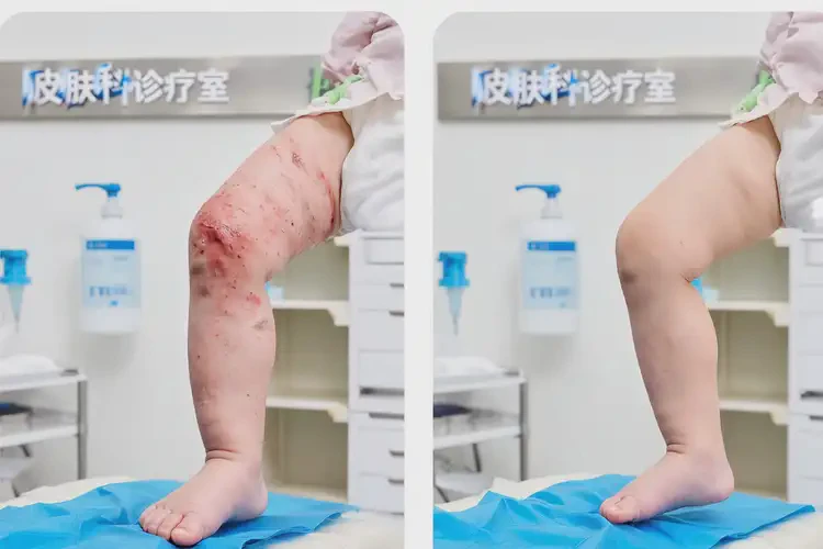 婴幼儿小腿有湿疹能治好吗(图1)