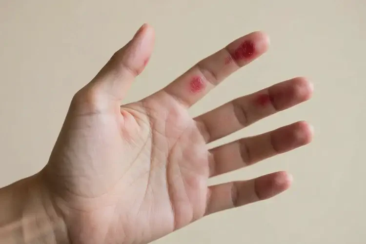 青年人手上偶尔长湿疹可以治好吗(图4)