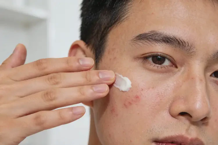 男人脸上有湿疹可以彻底自愈吗(图1)