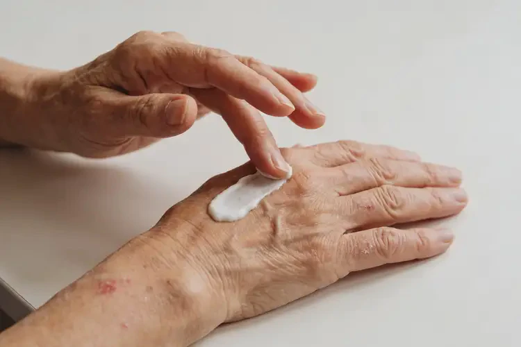 老年人手上容易起湿疹不管它会自己痊愈吗(图4)