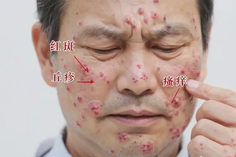 男性面部经常长湿疹可以治好吗(图4)