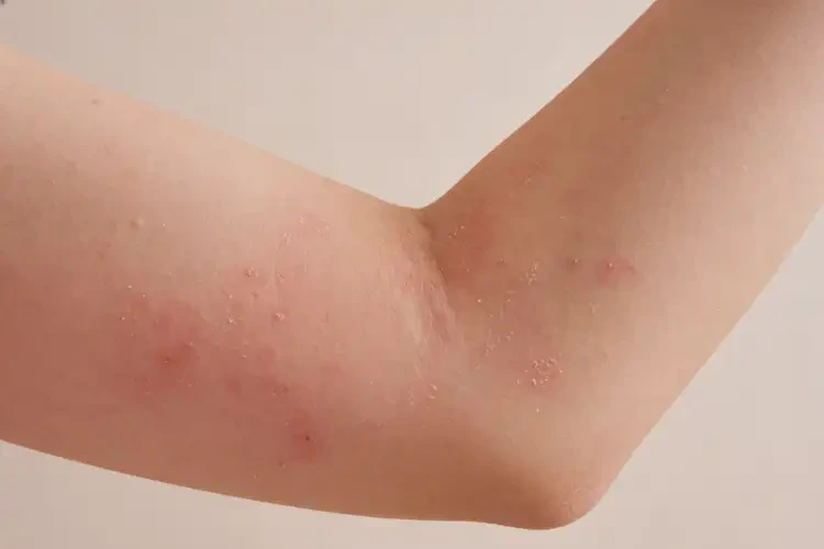 女人手臂偶尔长湿疹可以治好吗(图3)