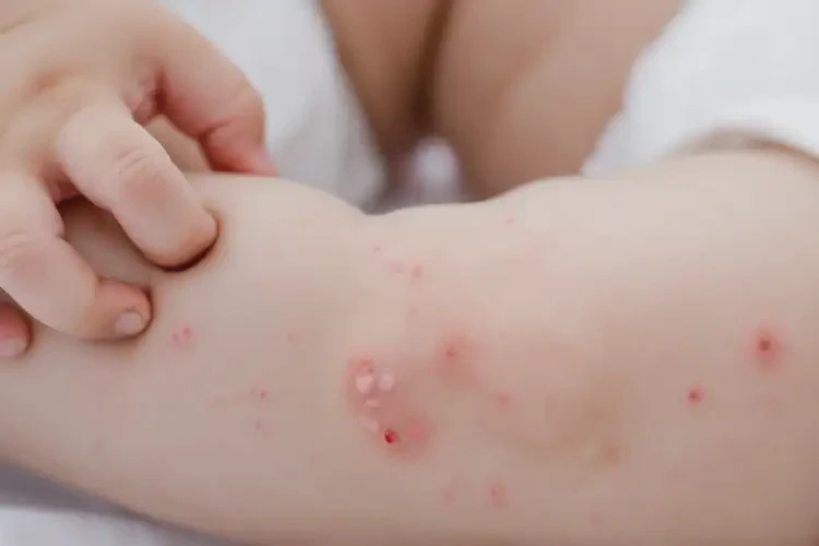 小儿小腿上经常起湿疹可以治好吗(图4)