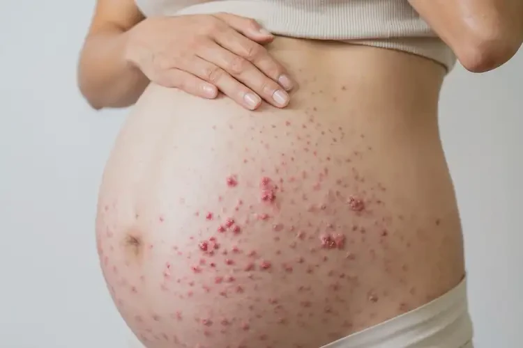 孕妇脖子偶尔长湿疹不管它会自己自愈吗(图4)