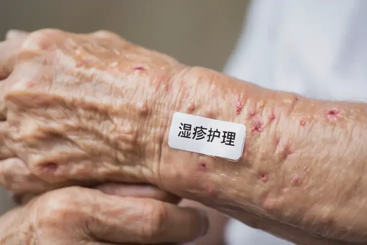 高龄老人手臂出现湿疹可以治好吗(图4)