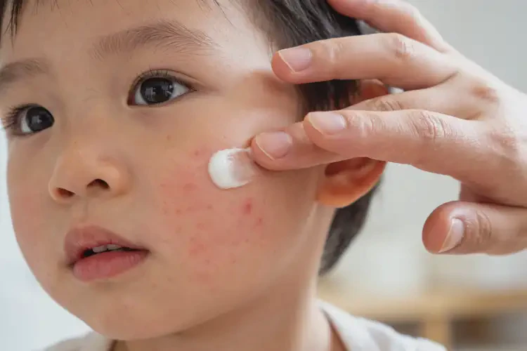 少儿面部偶尔起湿疹可以彻底自愈吗(图3)