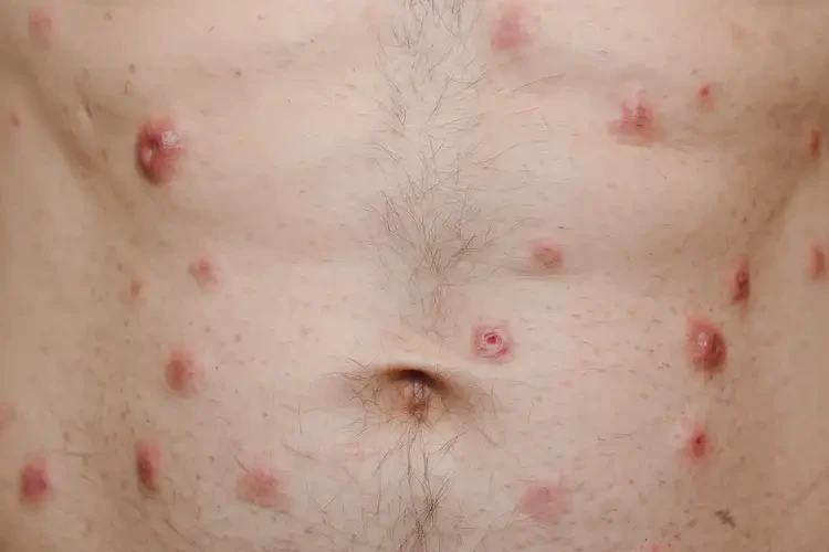 男人肚子容易起湿疹可以治好吗(图4)