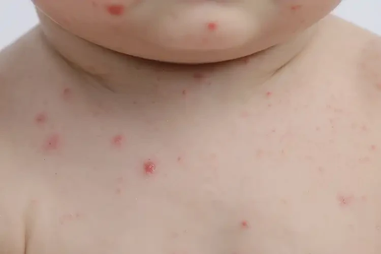 婴幼儿脖子起湿疹能治好吗(图4)