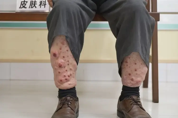 老年人小腿上经常长湿疹可以治好吗(图4)