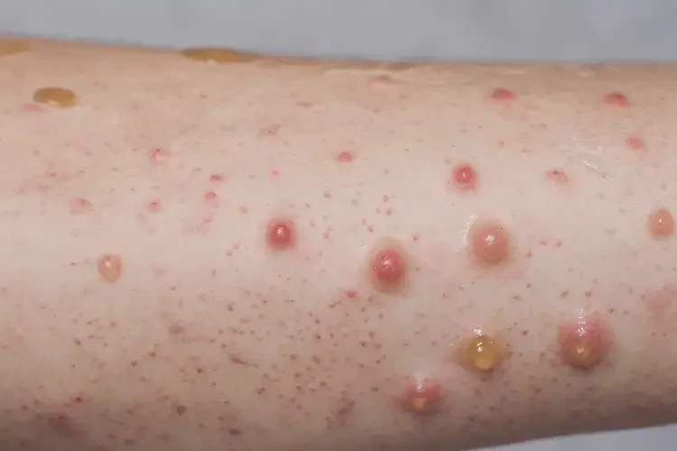 中学生手臂上经常起湿疹可以治好吗(图4)