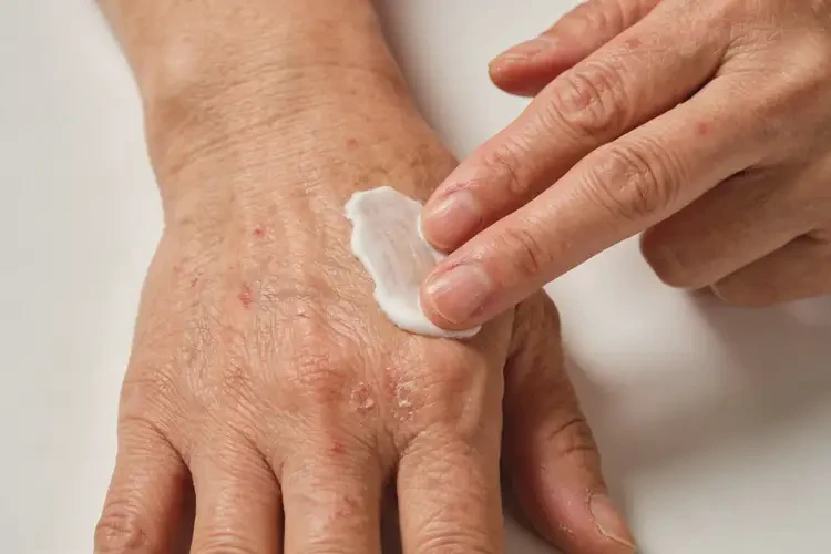 老年人手上容易起湿疹不管它会自己痊愈吗(图2)