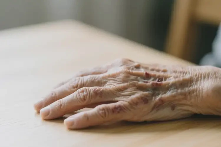 高龄老人手上偶尔起湿疹可以治好吗(图3)