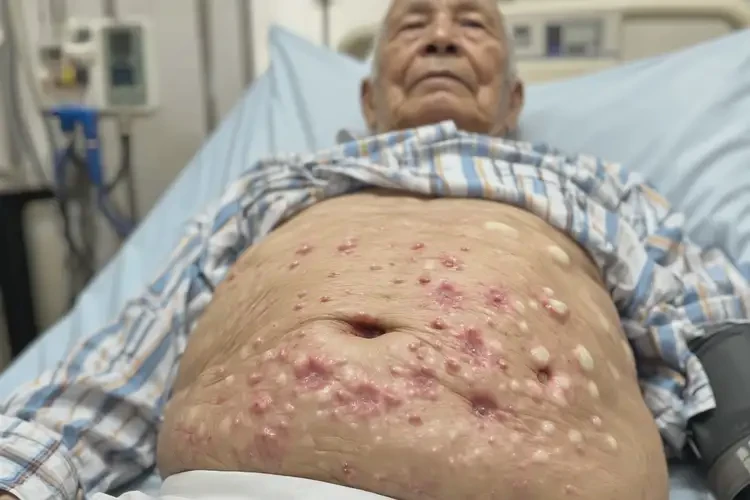 高龄老人肚子上经常长湿疹不管它会自己好吗(图4)