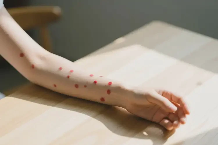 女性手臂上偶尔长湿疹可以治好吗(图2)