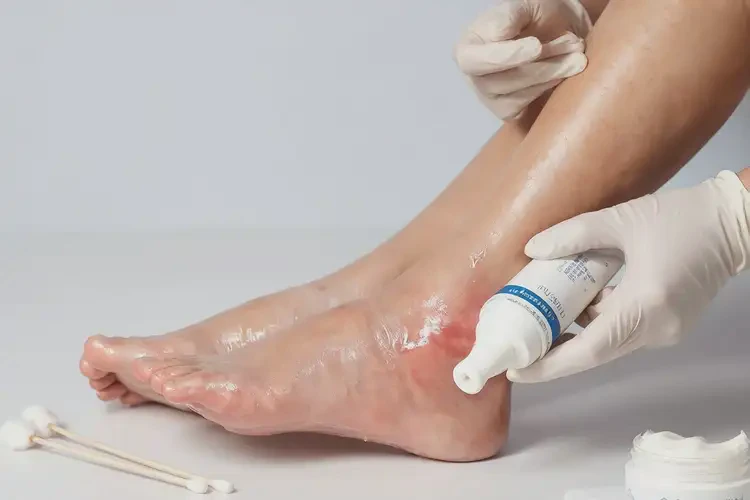 男人脚上经常长湿疹不管它会自己自愈吗(图3)