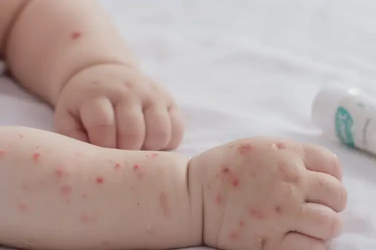 婴幼儿手臂经常长湿疹能靠自己自愈吗(图4)