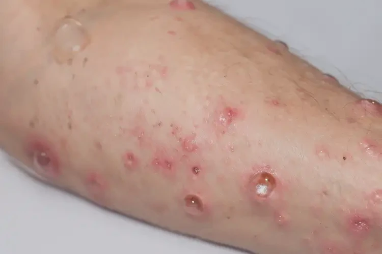 女人手臂上起湿疹可以治好吗(图3)