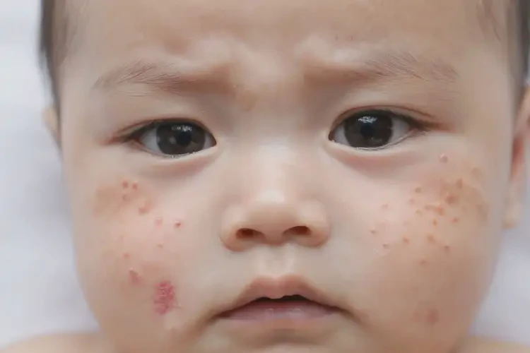 婴儿脸上经常起湿疹能治好吗(图4)
