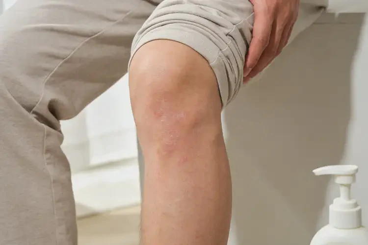 男人小腿上经常起湿疹可以治好吗(图3)