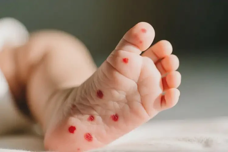 小儿脚上出湿疹可以治好吗(图4)