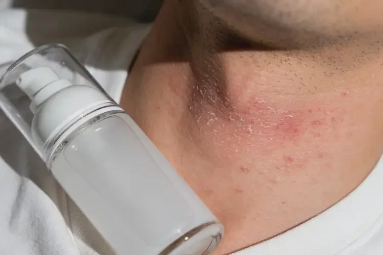 男人脖子上出现湿疹可以治好吗(图3)