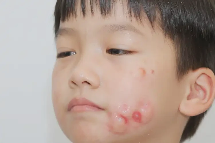 小学生肛周偶尔长湿疹能不能彻底自愈(图4)