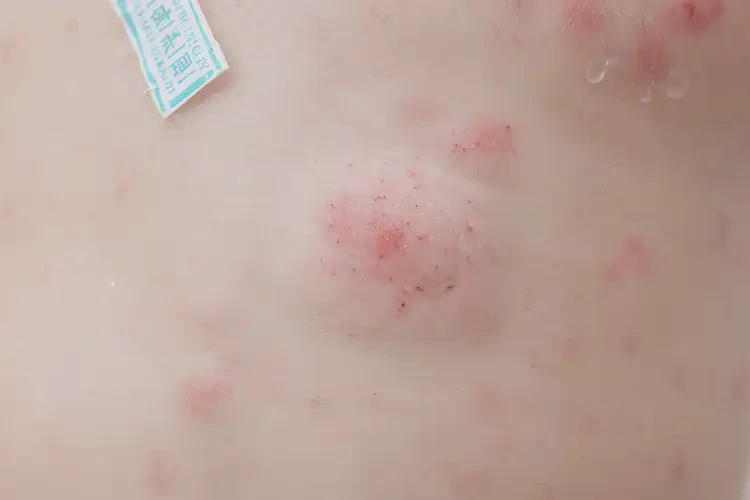 婴儿肛周长湿疹能治好吗(图4)