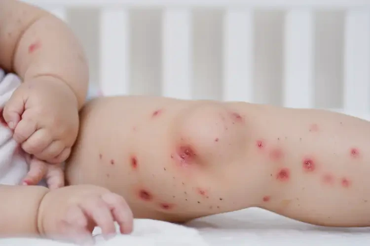 婴幼儿大腿上偶尔起湿疹能治好吗(图4)