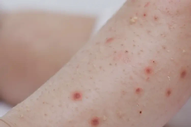 婴幼儿四肢出现湿疹能治好吗(图4)