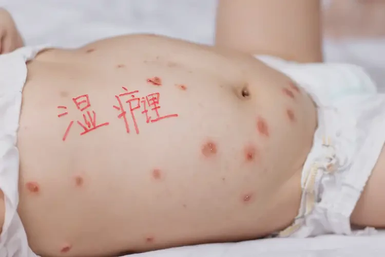 婴儿肚子容易起湿疹能治好吗(图4)