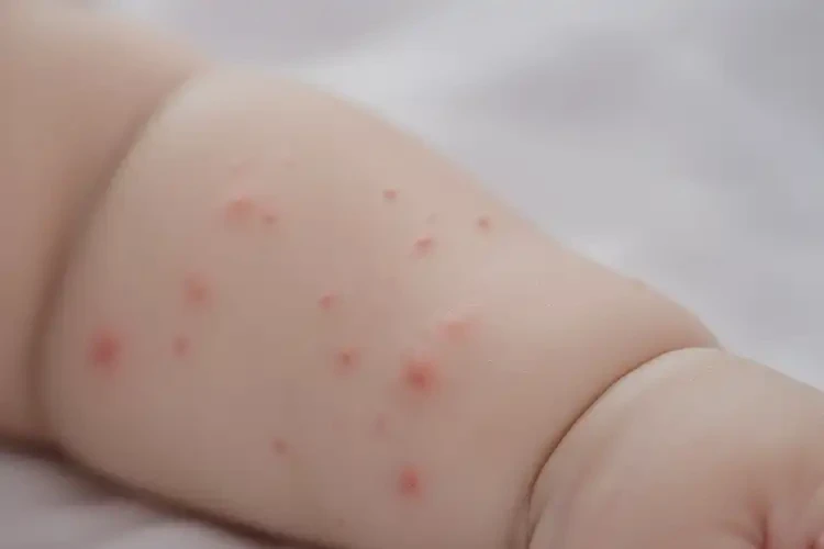 婴儿手臂经常长湿疹能治好吗(图4)