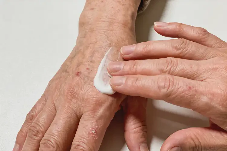 老年人手上容易起湿疹不管它会自己痊愈吗(图3)