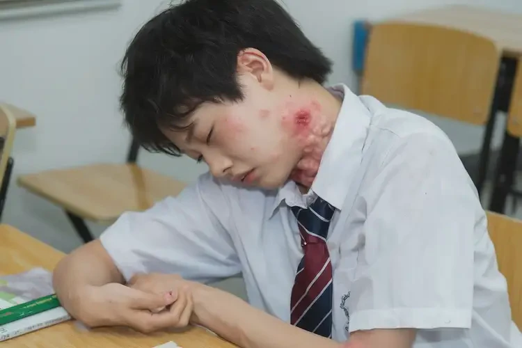 中学生四肢经常起湿疹可以治好吗(图4)