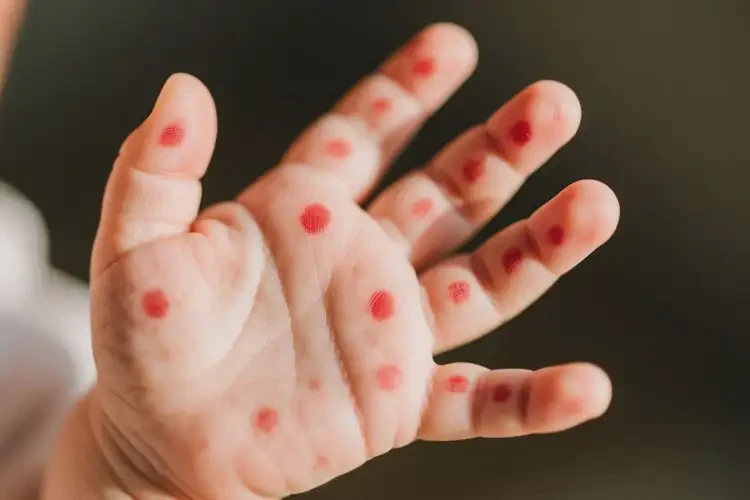 宝宝手上偶尔起湿疹能治好吗(图4)