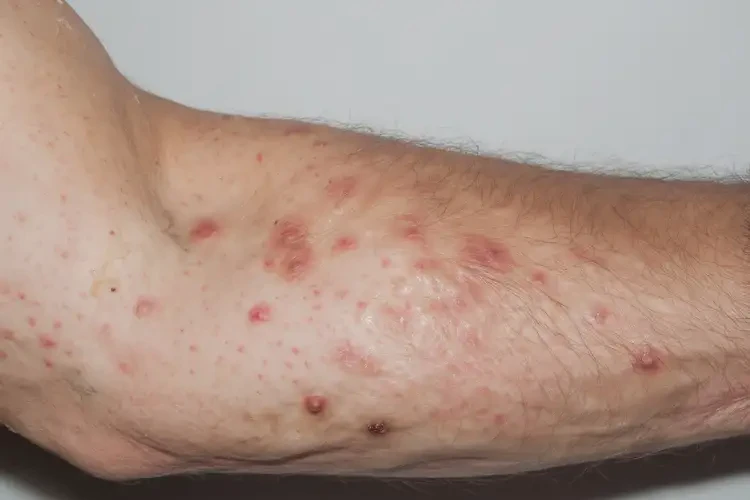 男人手臂上有湿疹可以治好吗(图4)